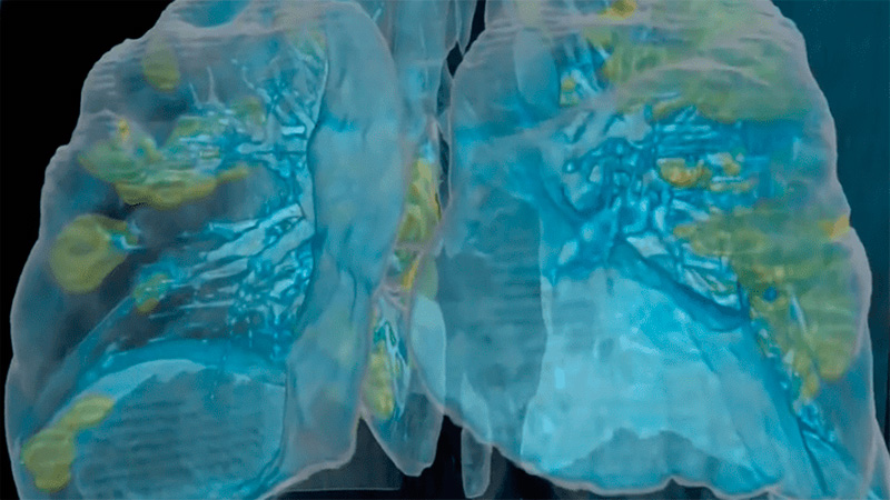 pulmones-covid