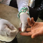 hepatitisb_